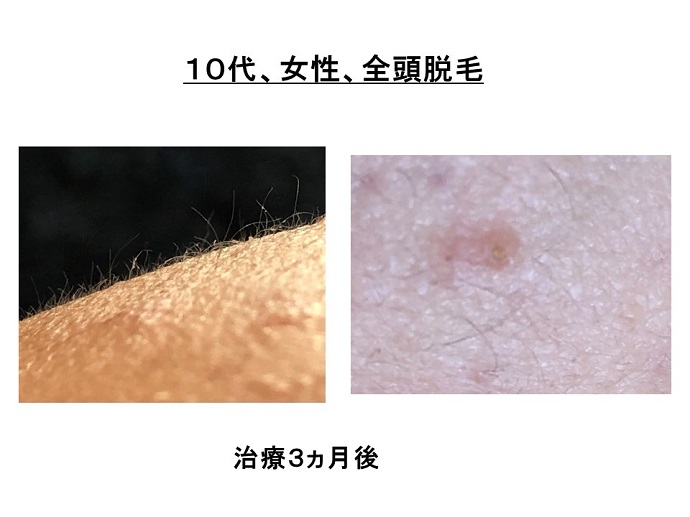 円形脱毛症　病院